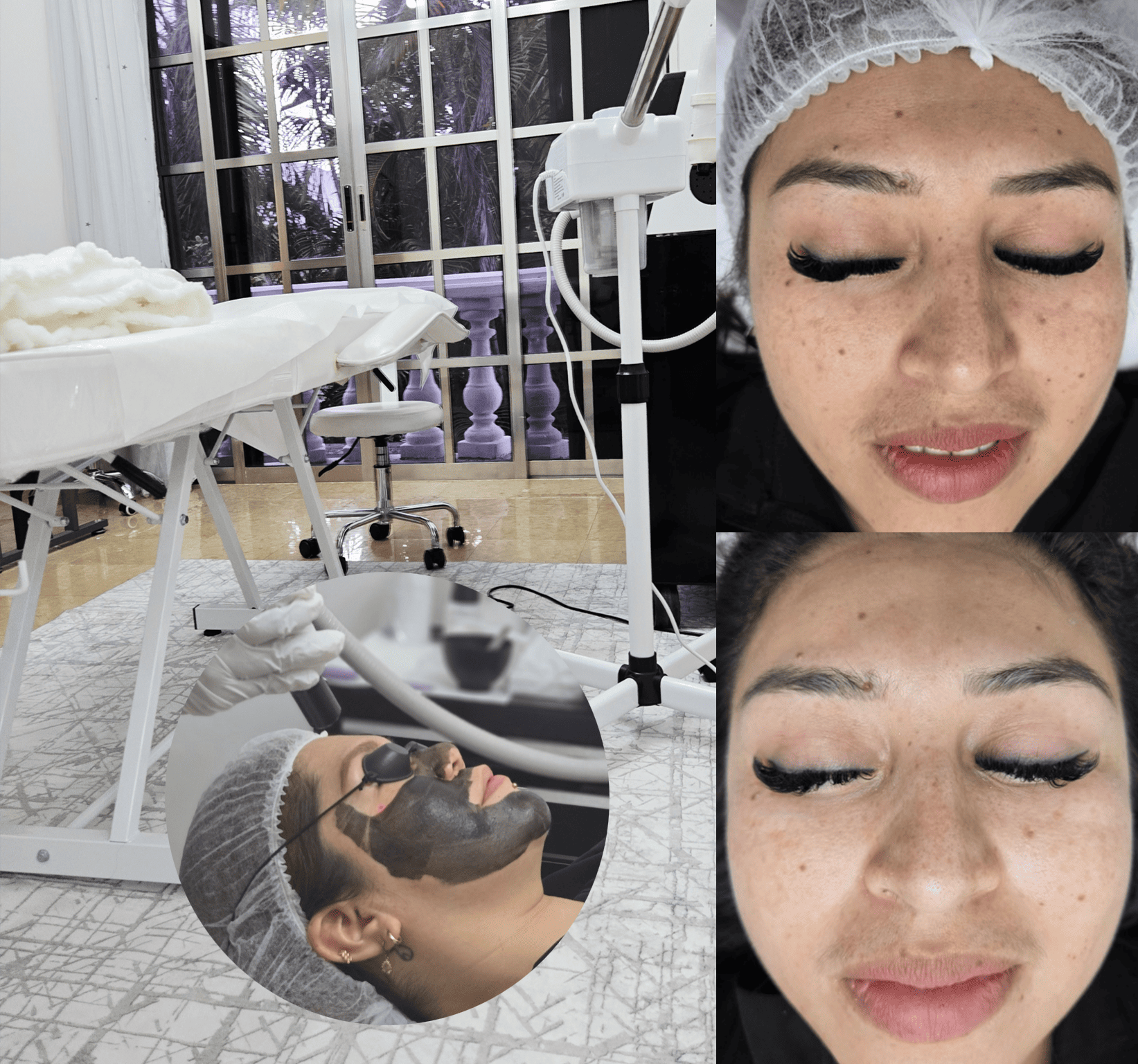 Procedimiento Hollywood Peel con láser y carbón activado