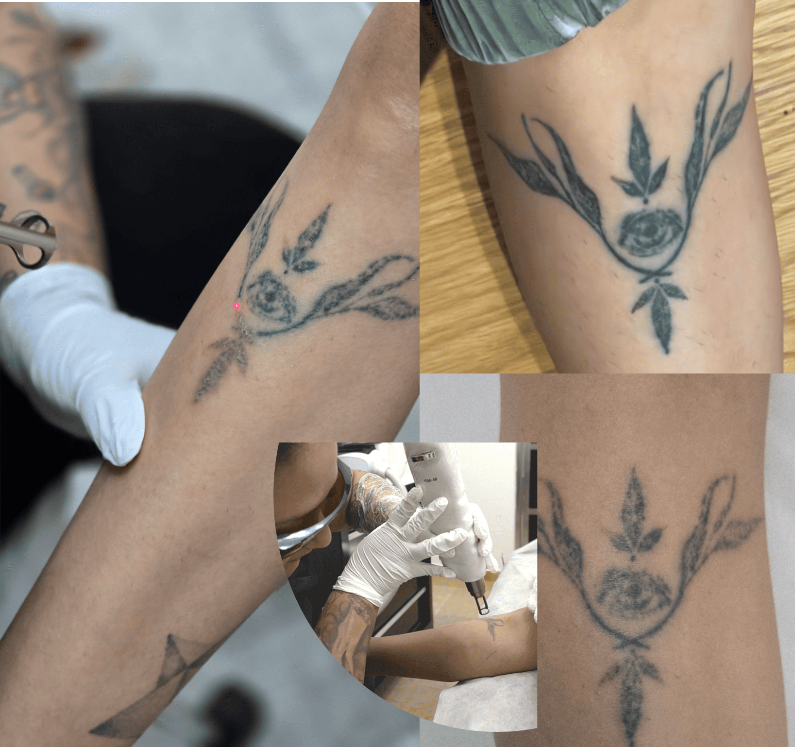 Procedimiento de eliminación de tatuaje con láser
